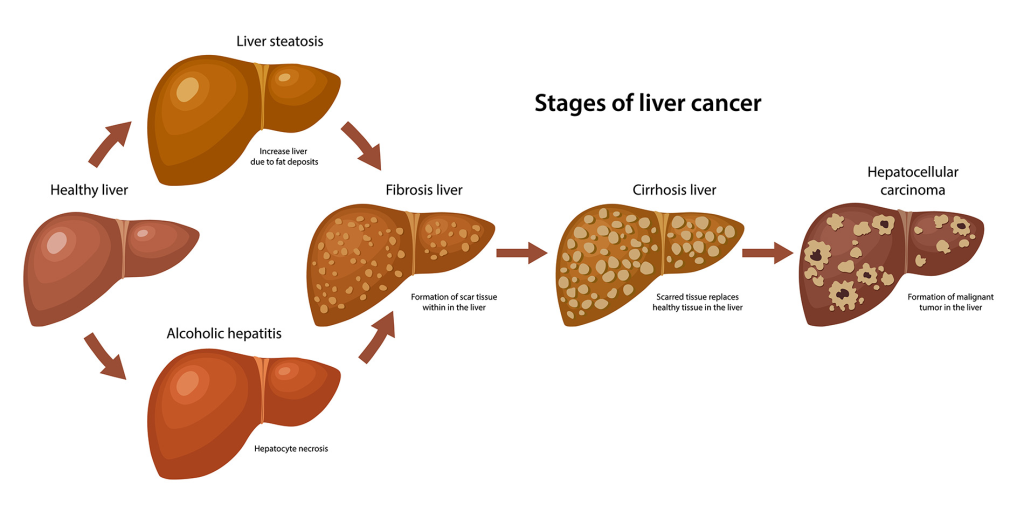 Bile Imbalance Linked to Liver Cancer: New Insights